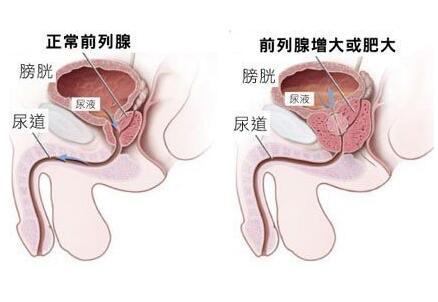 前列腺癌对人体的危害有哪些？