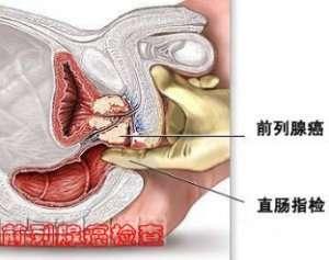 前列腺癌的临床表现和病因？